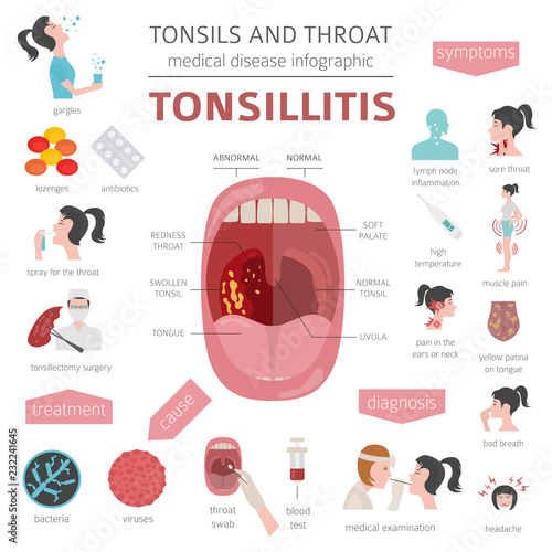 Tonsils and throat diseases. Tonsillitis symptoms, treatment icon set. Medical infographic design photo