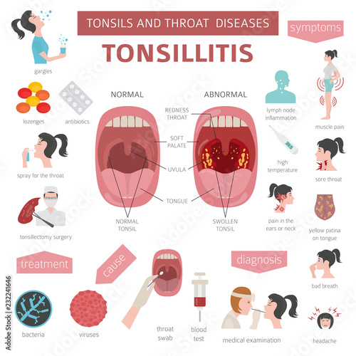 Tonsils and throat diseases. Tonsillitis symptoms, treatment icon set. Medical infographic design photo