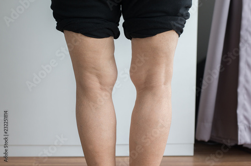 Photos Elderly woman leg bandy-legged shape of the body
