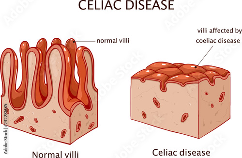 Photos Coeliac disease or celiac disease