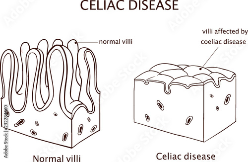 Coeliac disease or celiac disease. small bowel showing coeliac disease manifested by blunting of villi.