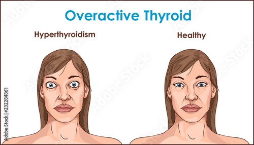 Face of an adult female exhibiting the symptoms of hyperthyroidism.