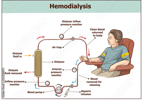 Hemodialysis procedure. Used for the renal insufficiency.