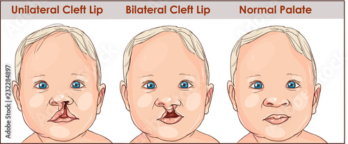 illustration of a cleft palate in a child. plastic surgery. reconstruction of the upper palate