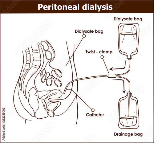 peritoneal dialysis are both used to treat kidney - vector illustration