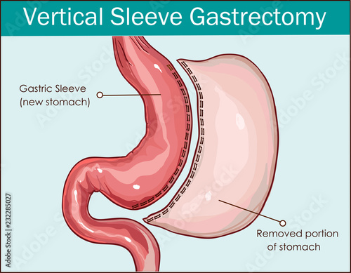 Vector illustration of Vertical Sleeve Gastrectomy