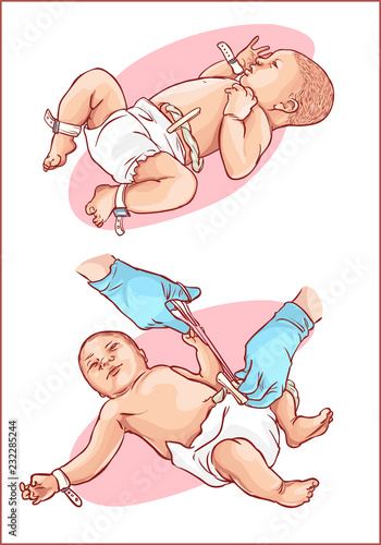 Cutting of the umbilical cord on a newborn baby