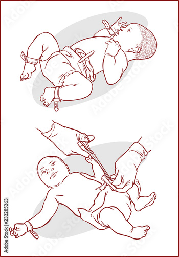 Cutting of the umbilical cord on a newborn baby