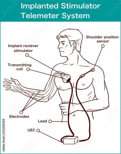 Implanted stimulator telemeter system