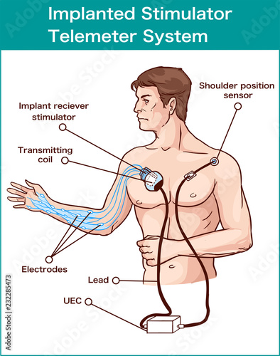 Implanted stimulator telemeter system