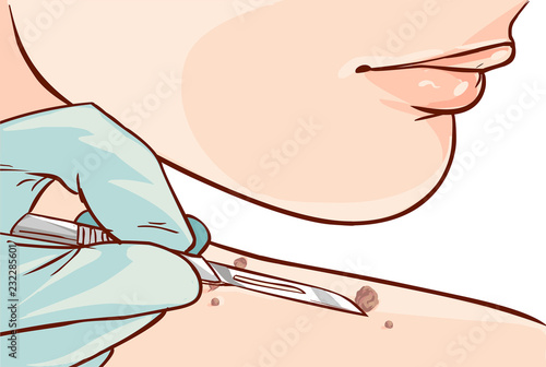 Vector illustration of a Skin Tag Removal Methods