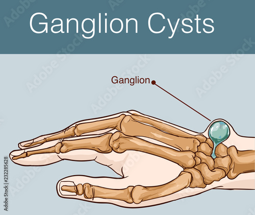 vector illustration of a Ganglion cyst