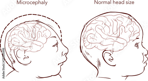 Illustration of a newborn baby with Microcephaly disease caused by Zika virus