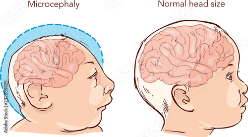 Illustration of a newborn baby with Microcephaly disease caused by Zika virus