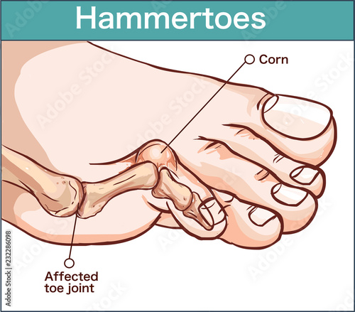 vector illustration of a hammertoes . photo