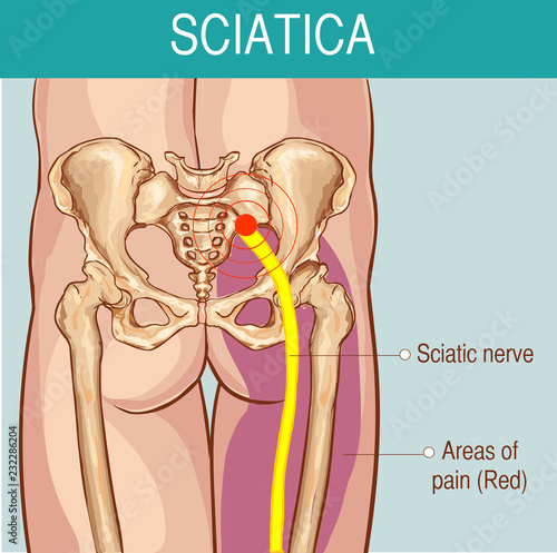 medical illustration of symptoms of sciatica
