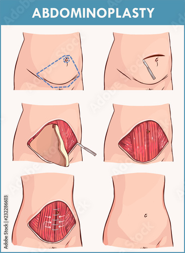 Vector illustration of a abdominoplasty and Lipectomy Procedures