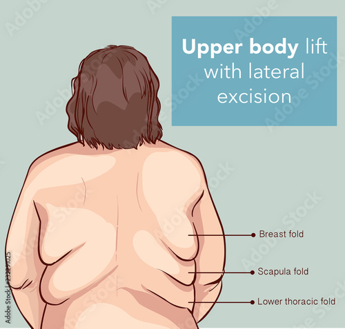 UPPER BODY LİFT WİTH LATERAL EXCİSİON2
