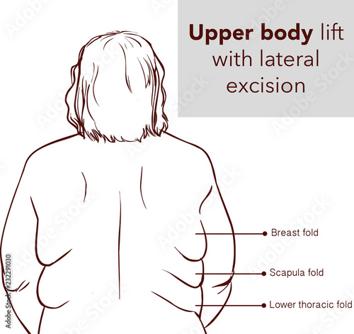 UPPER BODY LİFT WİTH LATERAL EXCİSİON2