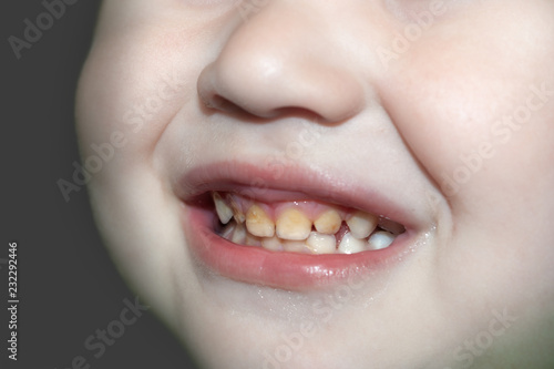 The boy’s broad smile demonstrates improper oral and dental care.