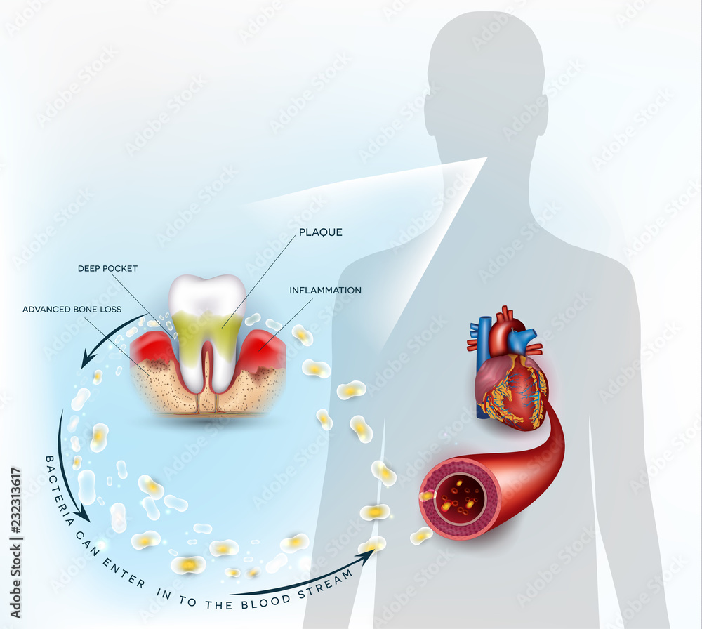 Fototapeta kuchenna Gum disease inflammation bacteria can enter in to ...