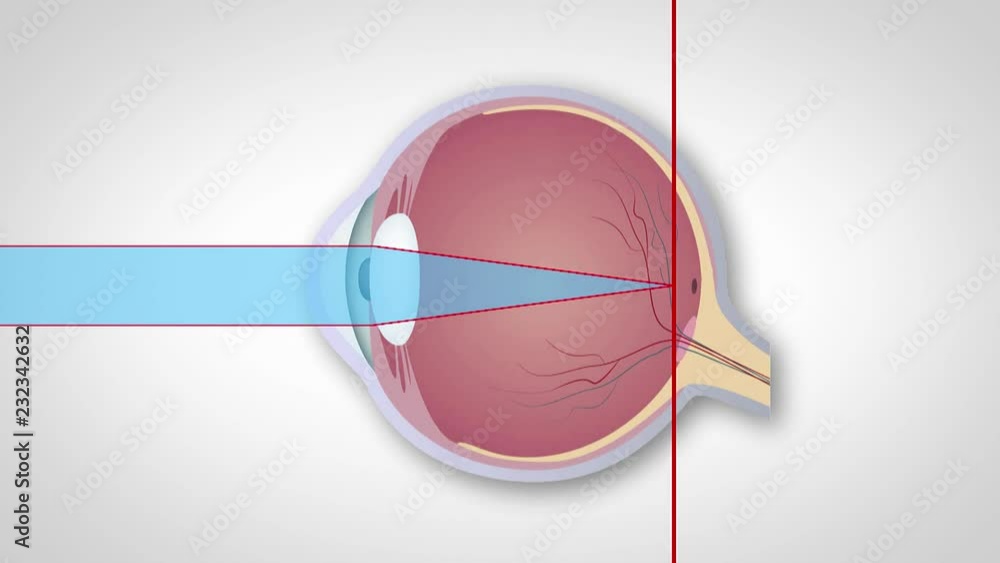 Hyperopia Vision Examples Schematic representation of hyperopia, myopia and astigmatism ...