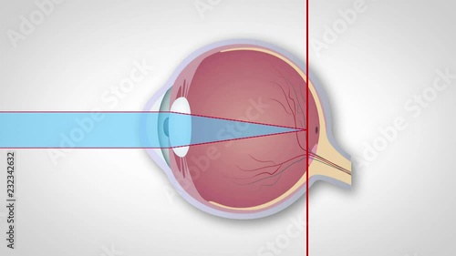 Schematic representation of hyperopia, myopia and astigmatism, Correction of various eye vision disorders by lens. Hyperopia, myopia and astigmatism, photo