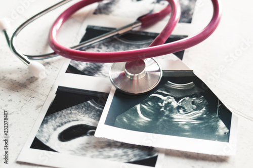 In the pictures of the ultrasound 4 weeks of pregnancy and 20 weeks is a phonendoscope. The concept of the study of pregnancy. Observation Selective focus.