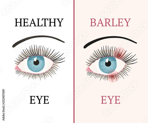 Eye disease. Ophthalmology health illustration.