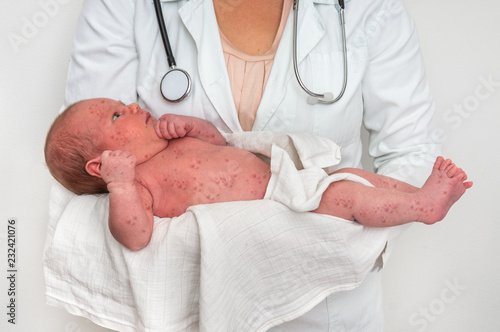 Doctor holding a newborn baby which is sick rubella or measles photo