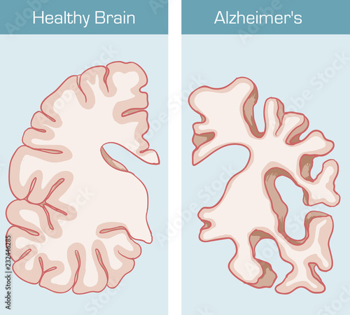 Alzheimer's Disease is a medical condition affecting the brain