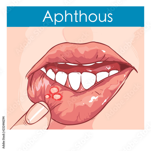  vector illustration of a Woman with aphthae on lip. photo