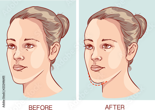 vector illustration of a Underbite Jaw surgery