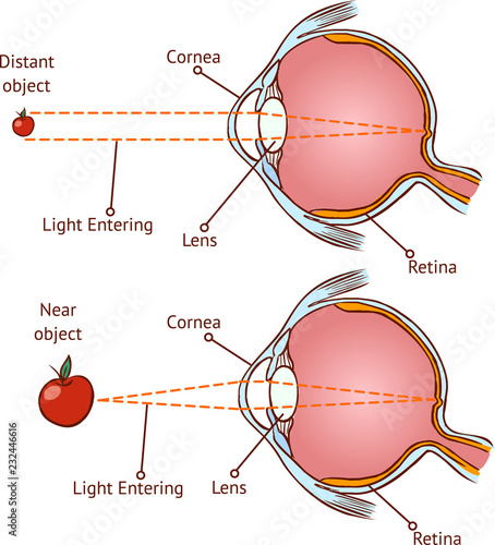 Myopia and normal vision ( color vector illustration )