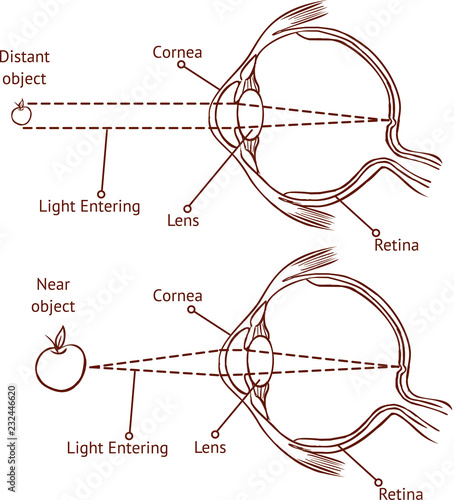 Myopia and normal vision ( color vector illustration )