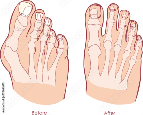 Human foot deformity. Hallux Valgus and tailors bunion.