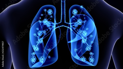 Secondary tuberculosis in lungs, apical nodule, 3D illustration photo