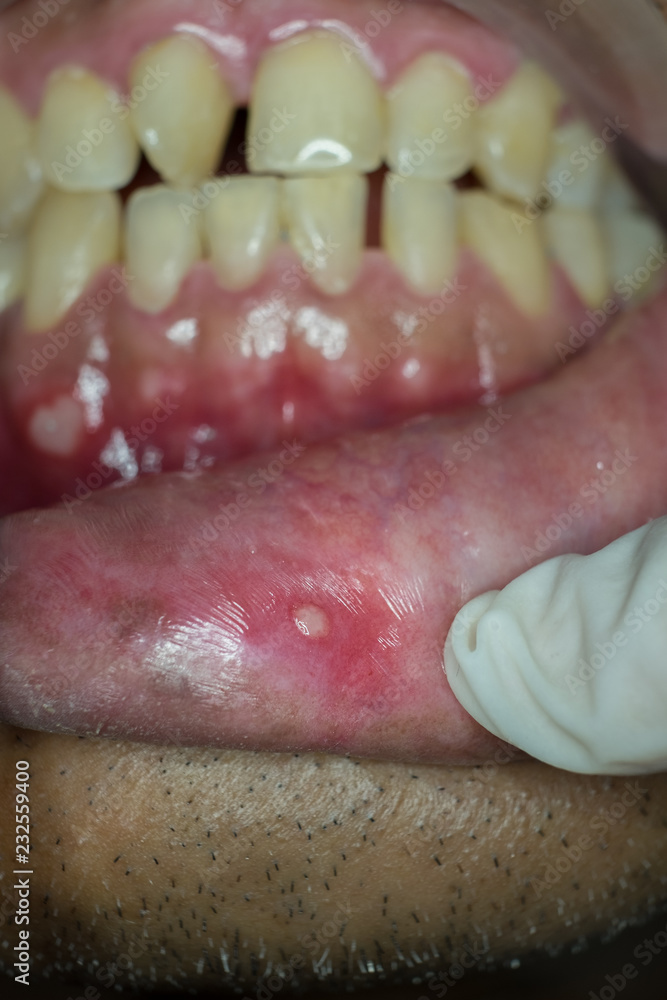 aphthous ulcer on lower lip