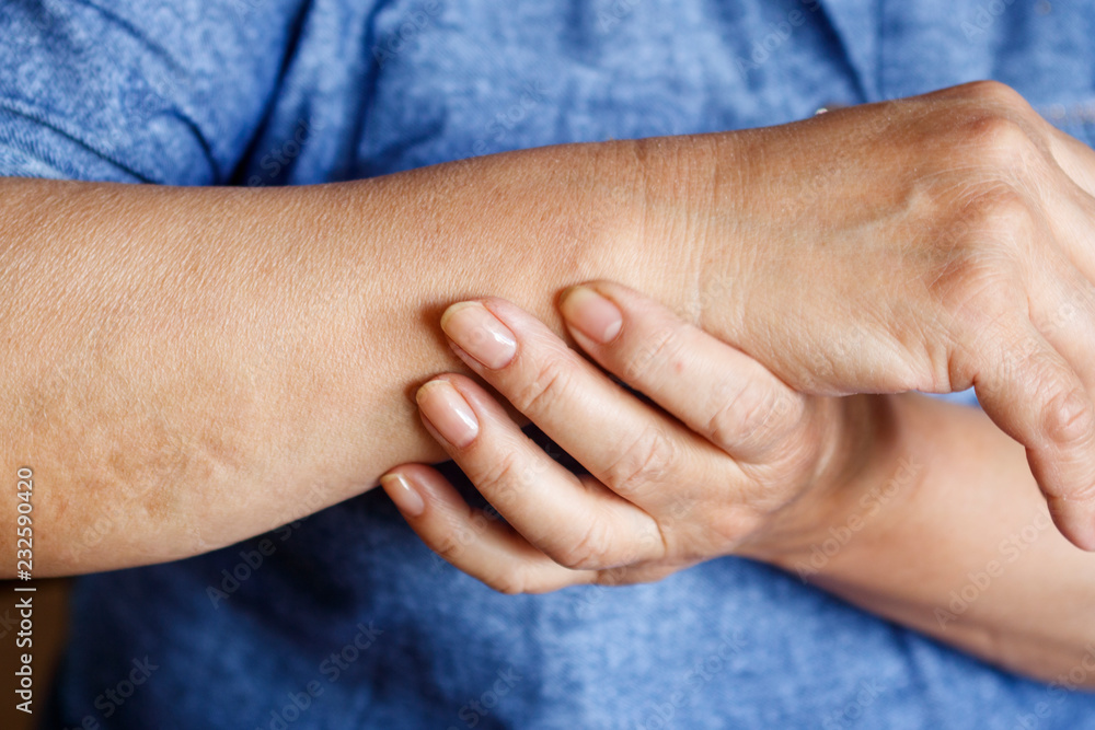 Hands of an elderly woman with arthritis closeup Hands of an elderly woman with arthritis closeup