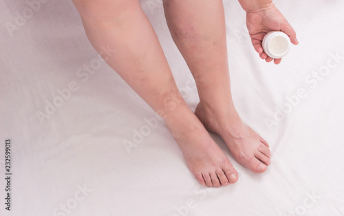 An elderly woman applies healing ointment to her leg on varicose veins, phlebeurysm legs, woman, white background, skincare, copy space
