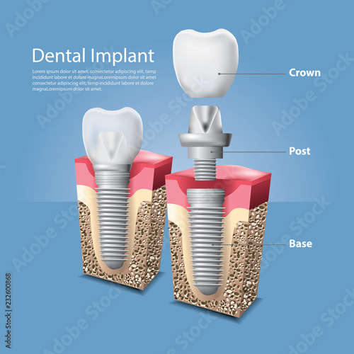 Human teeth and Dental implant Vector Illustration