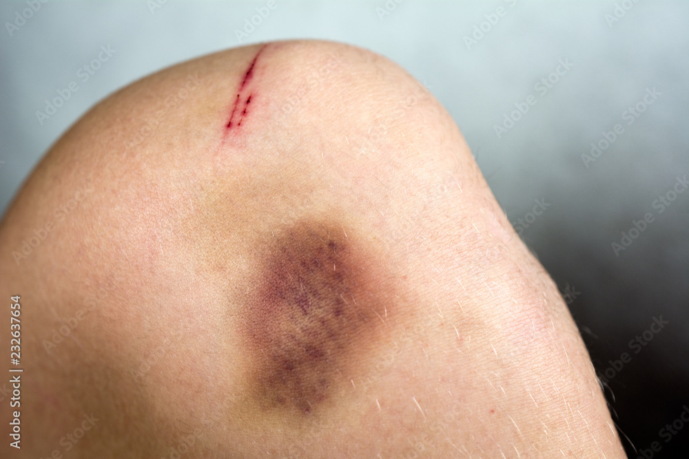Fototapeta premium broken knee. hematoma on the leg. Pain concept