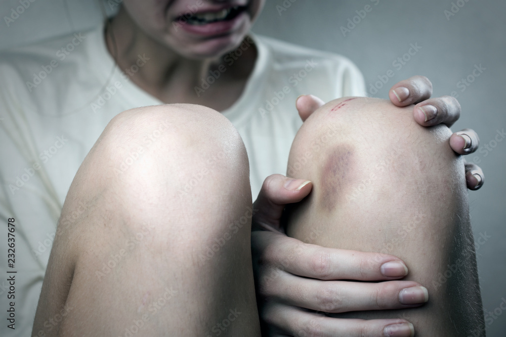 broken knee. Scared beaten up girl. bruise on the leg. domestic violence concept broken knee. Scared beaten up girl. bruise on the leg. domestic violence concept