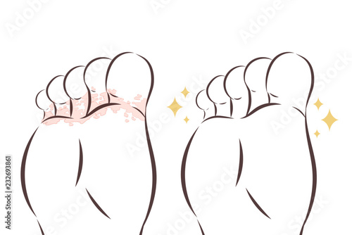 close up of Athlete foot