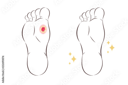 ulcers on the foot