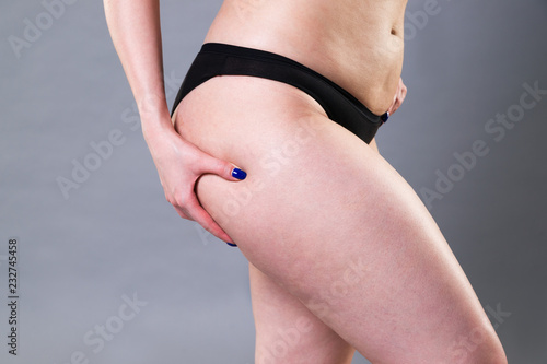 Woman holding fold of skin, cellulite on female body on gray background