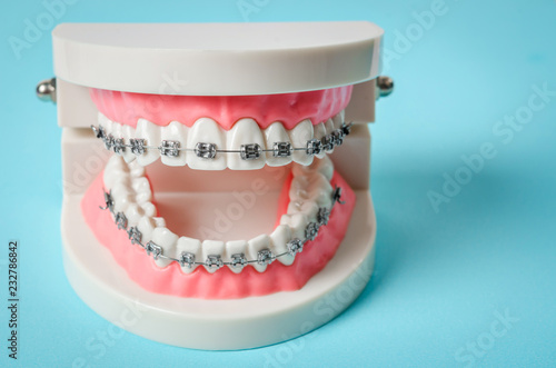 Fototapeta Naklejka Na Ścianę i Meble -  tooth model with metal wire dental braces.