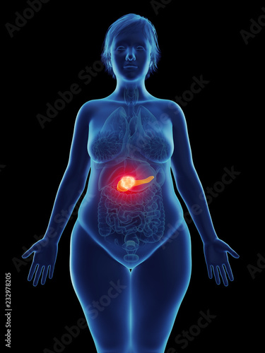 3d rendered medically accurate illustration of a tumor in a womans pancreas
