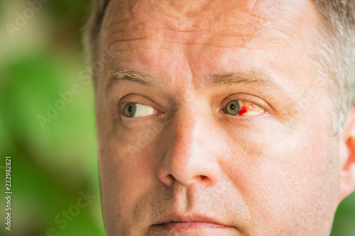Close up of man with broken blood vessel in eye. Subconjunctival bleeding