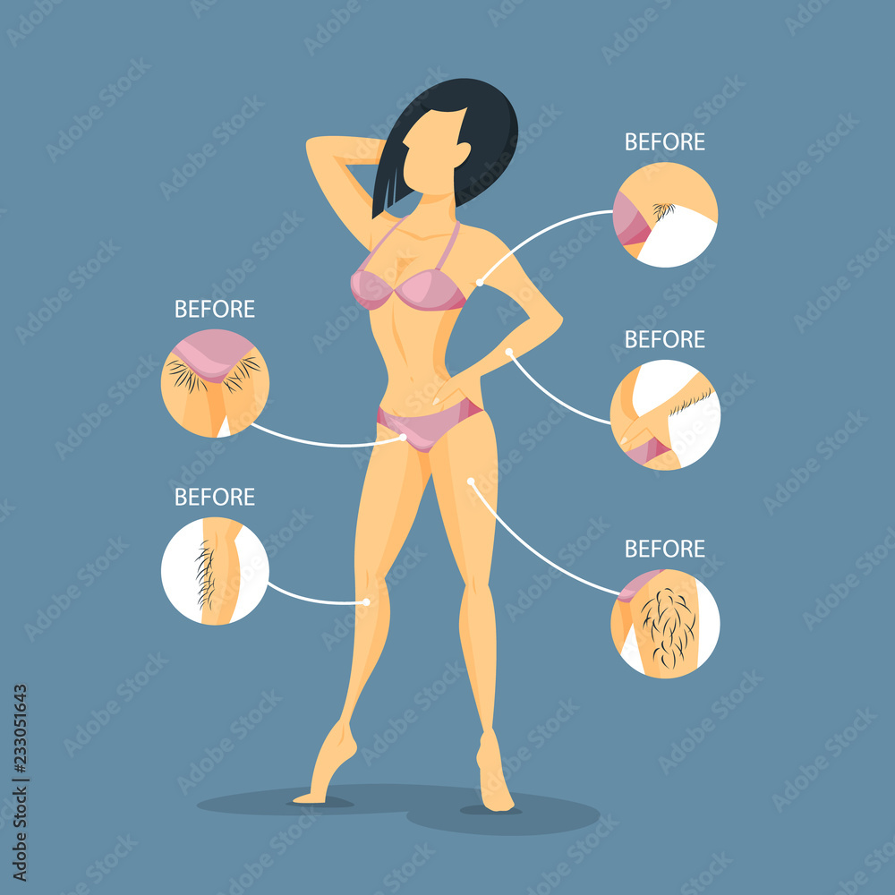 Epilation before and after. Armit and bikini zone Stock Vector Adobe